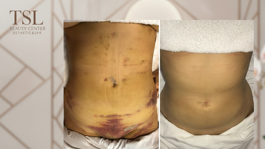 Lymphatic Drainage Massage