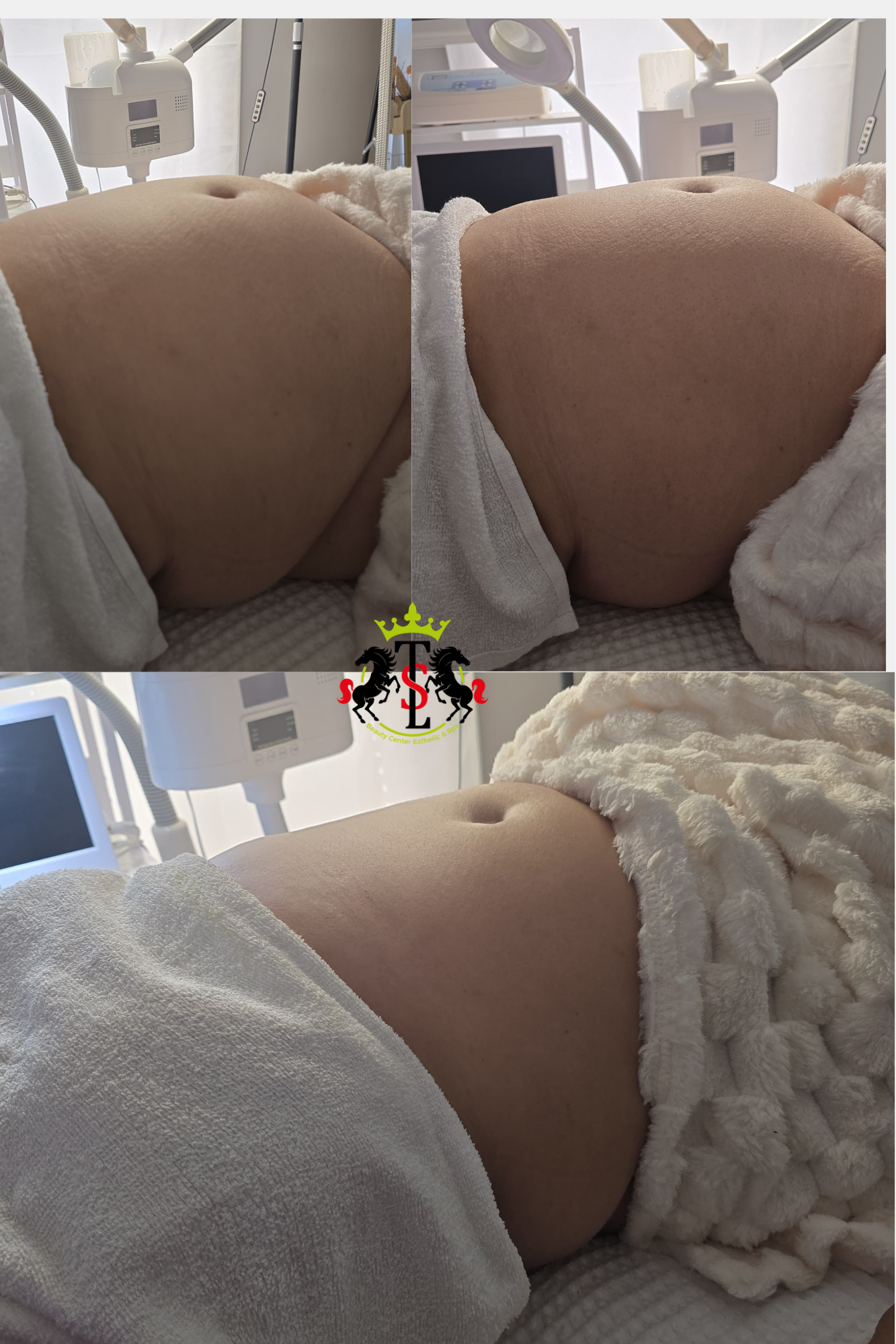 Abdomen 80 K Cavitation
