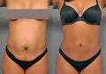 Flanks 80K Cavitation