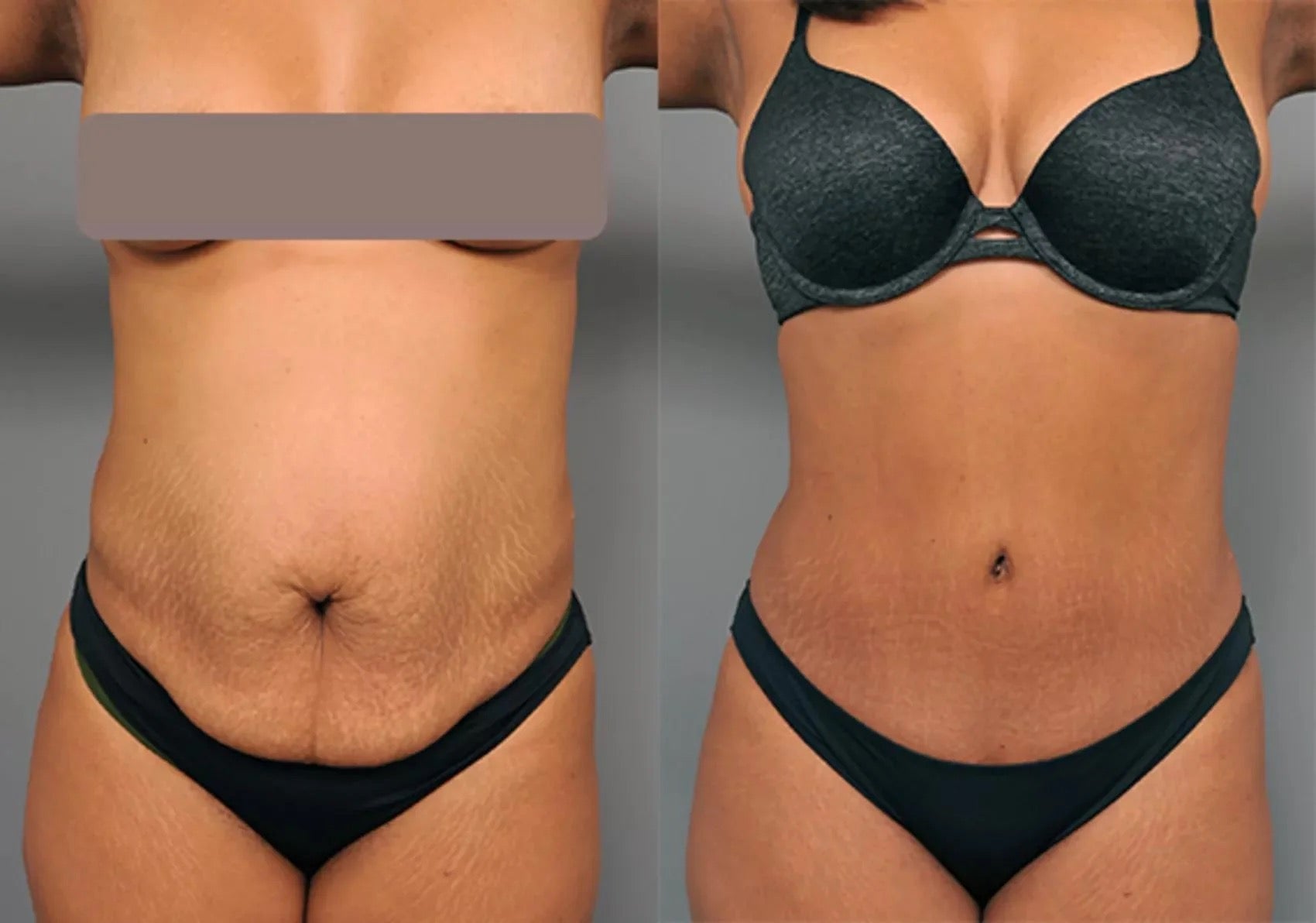 Flanks 80K Cavitation