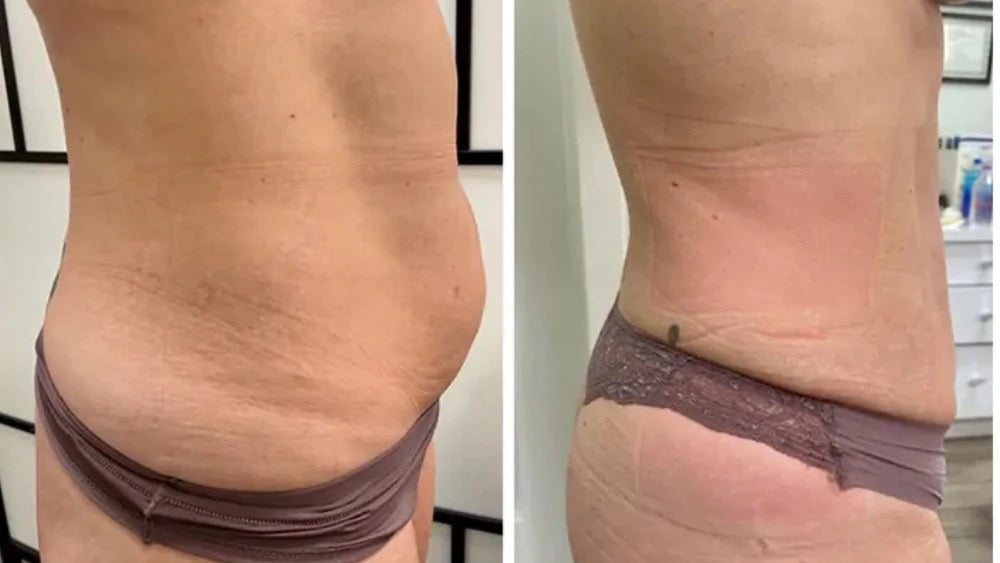 4 Area Body Sculpting Packages 80 K Cavitation