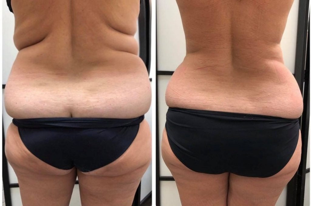 4 Area Upper Body Sculpting 80 K Cavitation