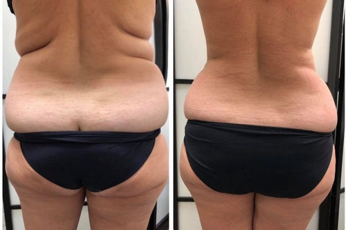 4 Area Upper Body Sculpting 80 K Cavitation