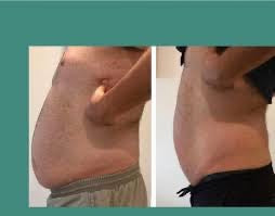 Abdomen Sculpting Packages