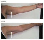 Arms (Both) 80 K Cavitation