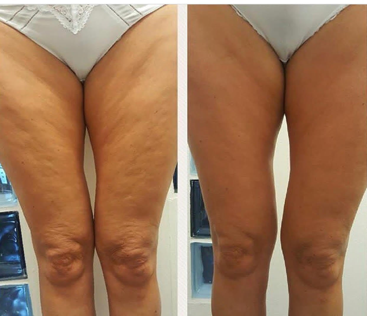 80K-Ultrasonic Cavitation Body Contouring