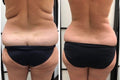 Lower Back 80 K Cavitation