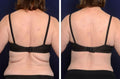 Upper Back 80 K Cavitation