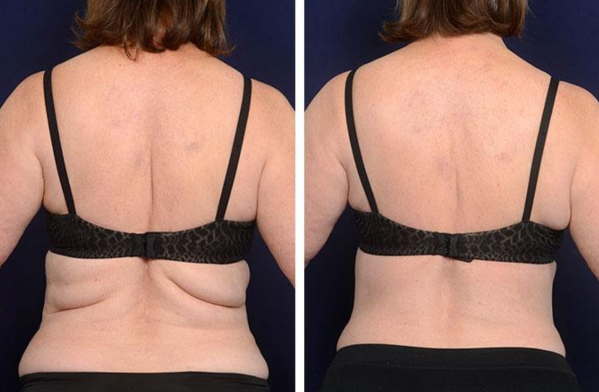 Upper Back 80 K Cavitation