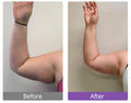 Arms (Both) 80 K Cavitation