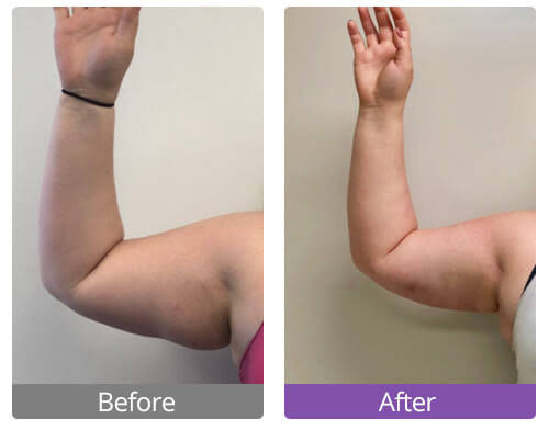 Arms (Both) 80 K Cavitation