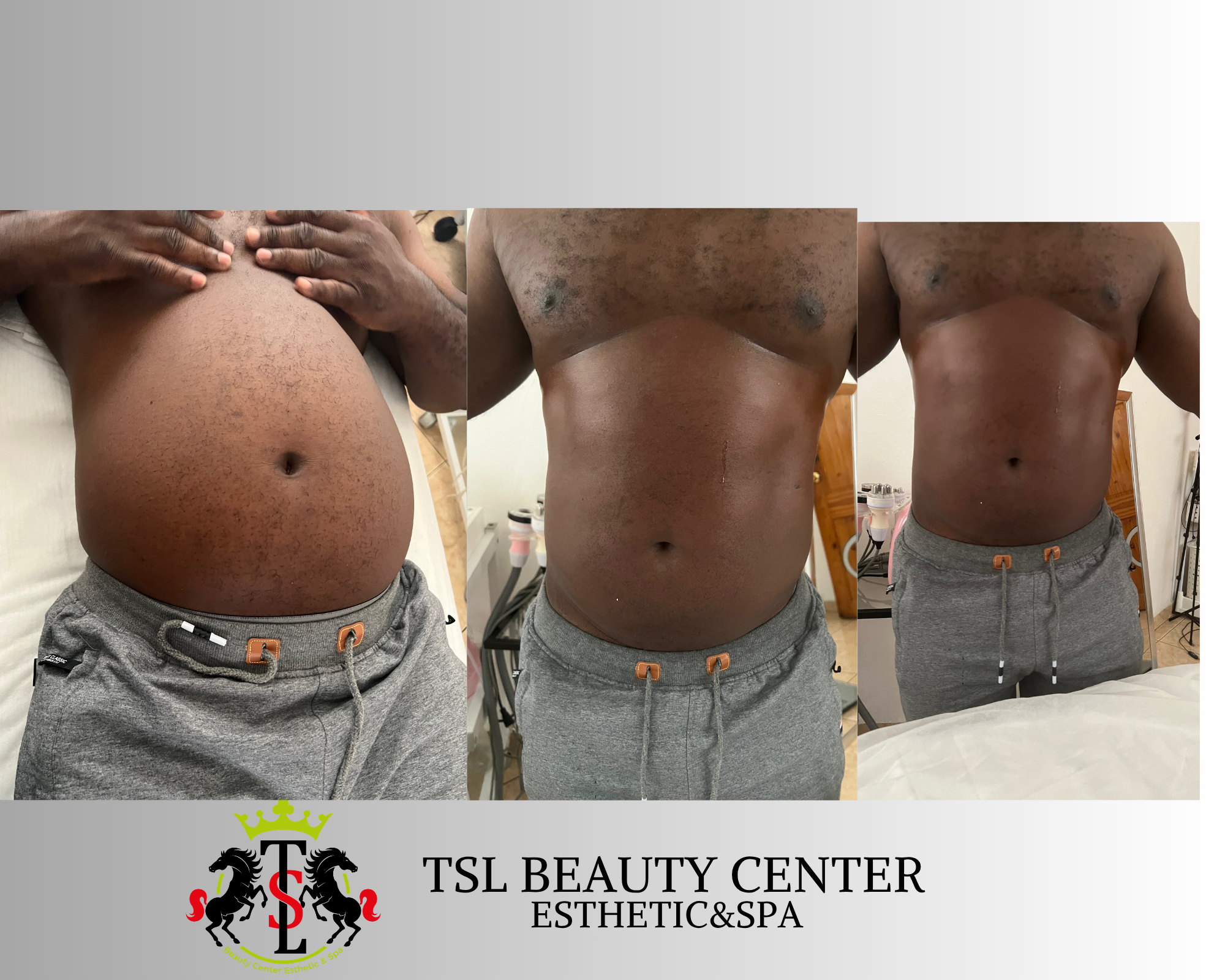 Abdomen 80 K Cavitation