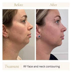 Face & Chin Transformation 80 k Cavitation