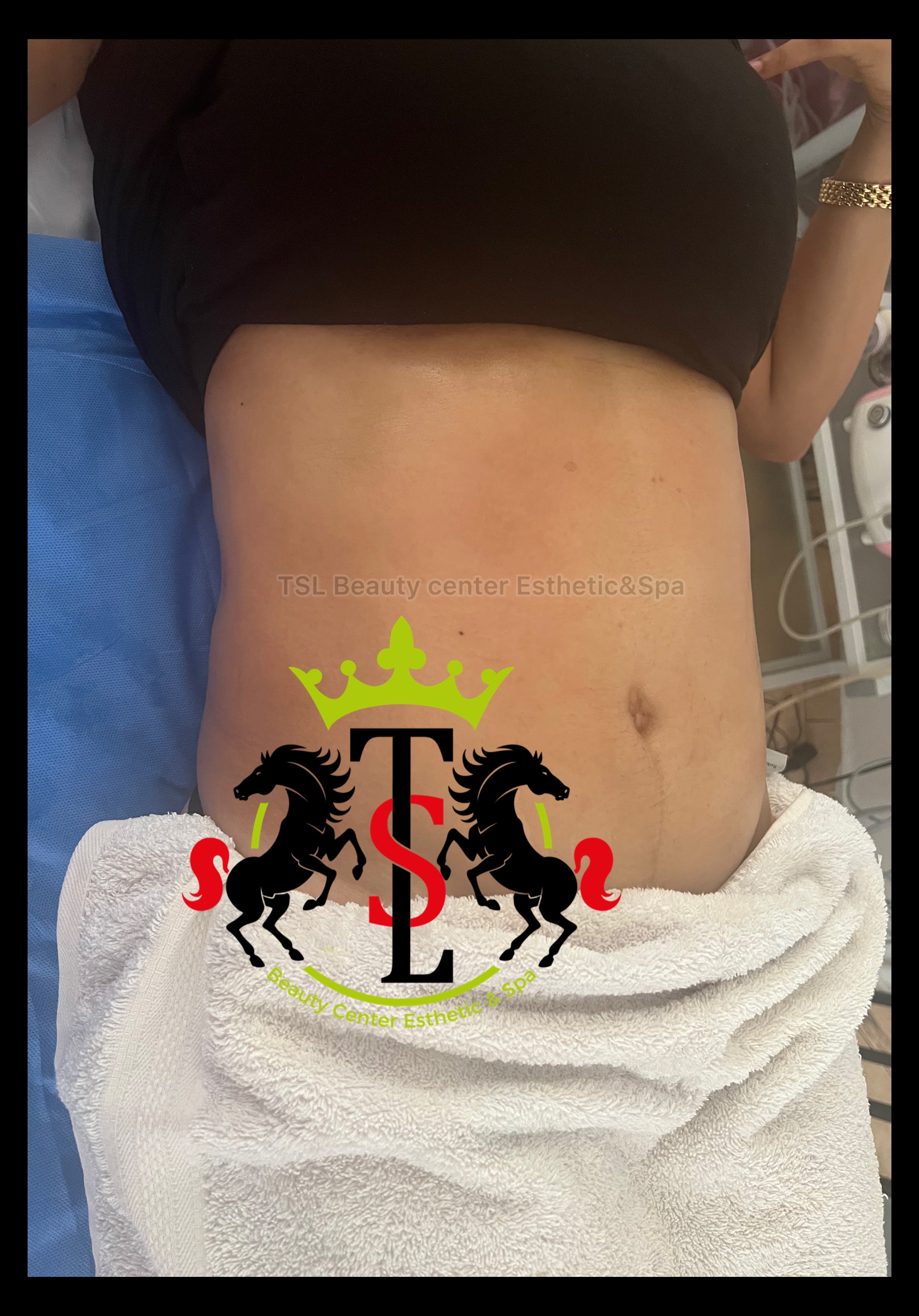 80K-Ultrasonic Cavitation Body Contouring