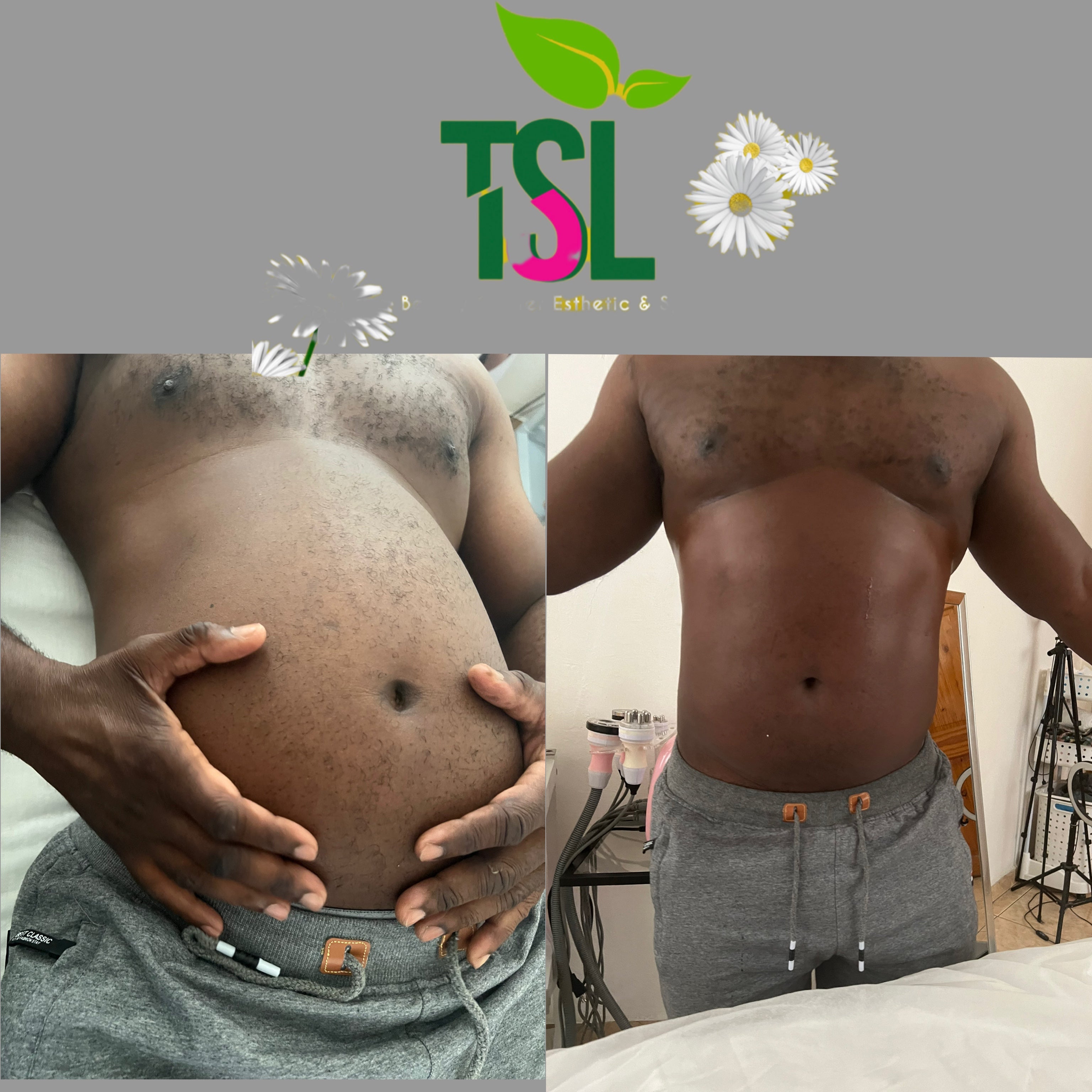 80K-Ultrasonic Cavitation Body Contouring