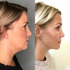 Face & Chin Transformation 80 k Cavitation